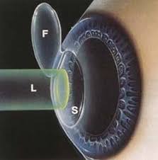 operasi Lasik 