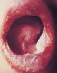 Stevens-Johnson syndrome.