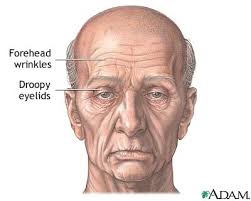 forehead wrinkles