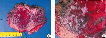 adenopatia inguinal