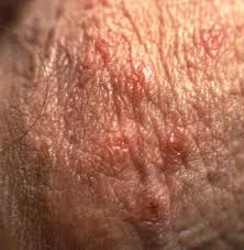 Genital Herpes May Never Go Dormant