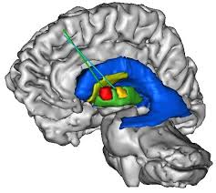 Neural graft in Huntington