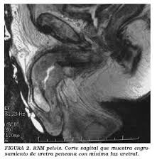 adenopatia inguinal