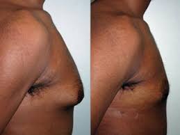 gynecomastia