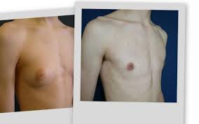 gynecomastia