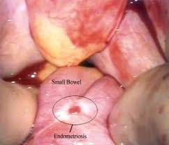 Endometriosis