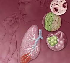 Pneumonia Contagious