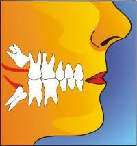 impac fullface Me duele mucho mi muela ¿Que hago?
