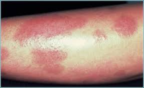 Pustular Psoriasis: