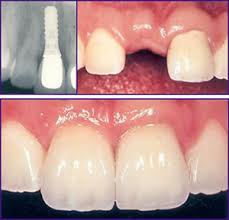 implante de titanio Has perdido dientes? Ayuda