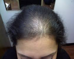  48% Of Women Have Thinning Hair!