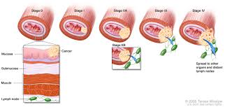 As esophageal cancer