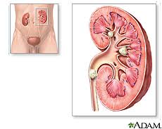 Illustration of kidney stones