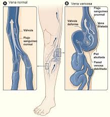 dthmdetm Cuida tu cuerpo, elimina tus varices
