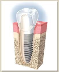 Dental Implant | Dentist | Ali Shirani | Antioch, CA