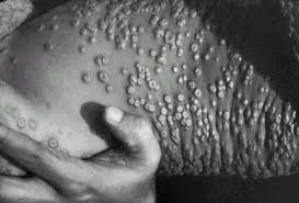 that smallpox not just for