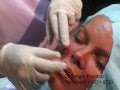 Dr Sergio Escobar aplicando