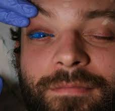 tattooing procedure