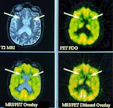 Huntingtons Disease