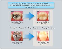 pictures tooth crown