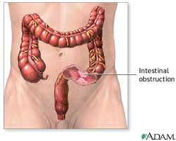 What is Colostomy?