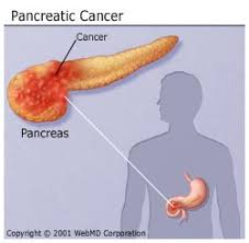 Pancreatic Cancer