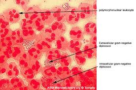 Gonorrhea: emily, gonorrhea
