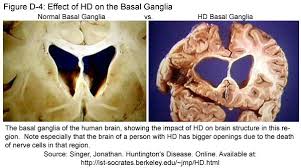 Juvenile Huntingtons Disease
