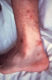Gonorrhea