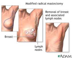 removed by lumpectomy.