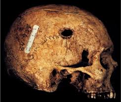 Forensic Anthropology