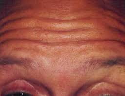 forehead wrinkles