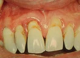 periodontitisNTnva ¿Cómo Identificar la Periodontitis?