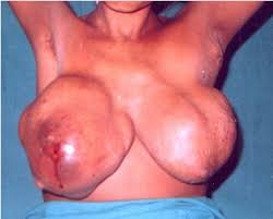 primary breast lymphoma