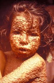 modern smallpox victim