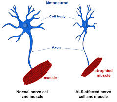 the early signs of ALS?