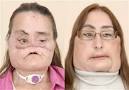 FACE TRANSPLANT patient: 'I'm not a monster' - Health - Health ...