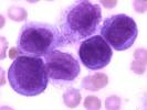 <b>acute monocytic leukemia</b>