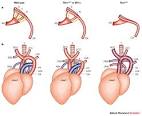 <b>Aortic arch syndrome</b> refers to