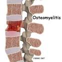<b>Osteomyelitis</b>