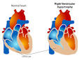 Ventricular <b>hypertrophy</b>