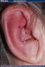 with <b>herpes zoster oticus</b>.