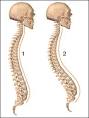 <b>Lordosis</b>