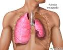 <b>Pulmón</b> colapsado, neumotórax: MedlinePlus enciclopedia médica