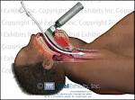 Endotrachael <b>Intubation</b> Close Up - Ear Nose & Throat