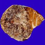 <b>Hepatoblastoma</b>.