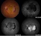 Classic <b>choroidal neovascular</b>