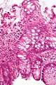 Inflammatory bowel <b>disease</b> - Wikipedia, the free encyclopedia