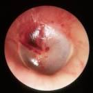<b>Herpes Zoster Oticus</b>