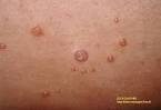 <b>Condylomes Acuminés</b>